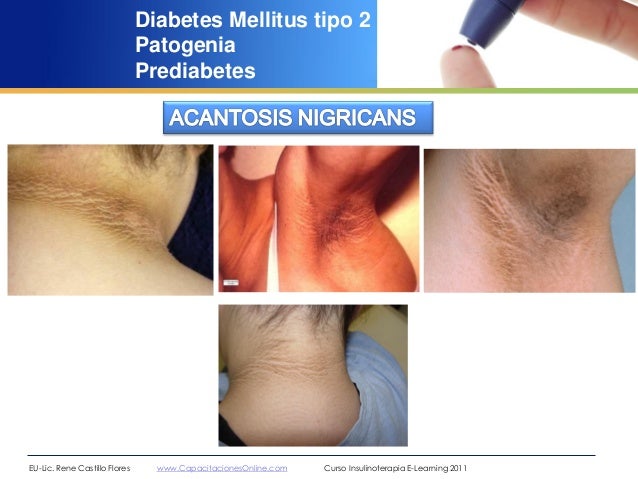 Generalidades diabetes mellitus rené castillo flores 2012 Generalidades diabetes mellitus rené castillo flores 2012