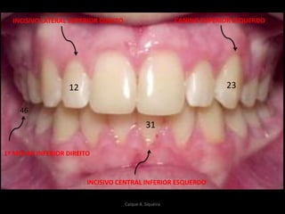 12
46
23
31
INCISIVO LATERAL SUPERIOR DIREITO
INCISIVO CENTRAL INFERIOR ESQUERDO
1º MOLAR INFERIOR DIREITO
CANINO SUPERIOR ESQUERDO
Caíque A. Siqueira
 