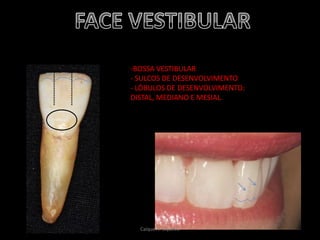 -BOSSA VESTIBULAR
- SULCOS DE DESENVOLVIMENTO
- LÓBULOS DE DESENVOLVIMENTO:
DISTAL, MEDIANO E MESIAL.
Caíque A. Siqueira
 