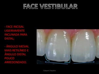 - FACE INCISAL
LIGEIRAMENTE
INCLINADA PARA
DISTAL;
- ÂNGULO MESIAL
MAIS RETILÍNEO E
ÂNGULO DISTAL
POUCO
ARREDONDADO.
Caíque A. Siqueira
 