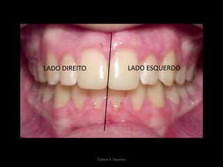 LADO ESQUERDOLADO DIREITO
Caíque A. Siqueira
 