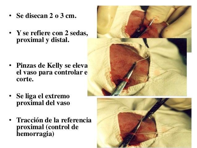 La tromboflebitis de las venas del miembro viril el tratamiento
