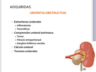 CÁLCULOS URETERALES
Se originan en riñón
Complicación de una infección
La mayoría se eliminan espontáneamente
Calcio 70-80...
