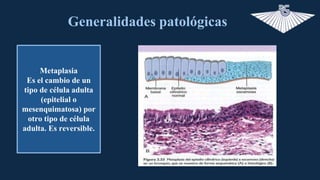 Generalidades patológicas
Metaplasia
Es el cambio de un
tipo de célula adulta
(epitelial o
mesenquimatosa) por
otro tipo d...
