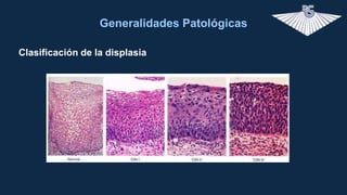 Generalidades Patológicas
Clasificación de la displasia
 