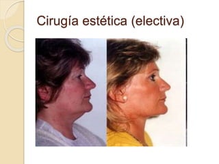 Cirugía estética (electiva)
 