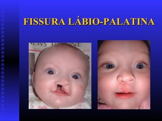 FISSURA LÁBIO-PALATINAFISSURA LÁBIO-PALATINA
 