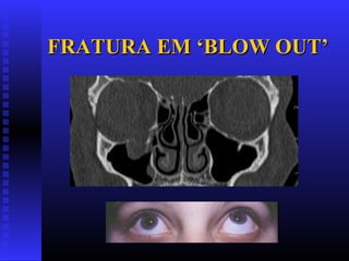 FRATURA EM ‘BLOW OUT’FRATURA EM ‘BLOW OUT’
 