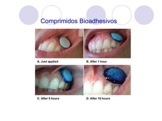 Comprimidos Bioadhesivos BEMA: disco mucoadhesivo bioerosionable 