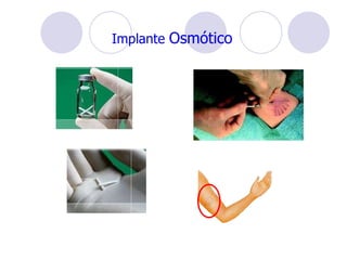 Implante  Osmótico 