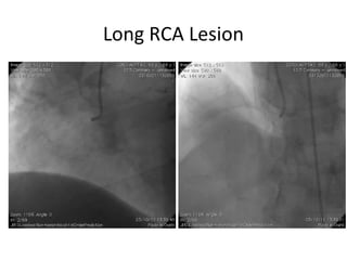 Long RCA Lesion 
 