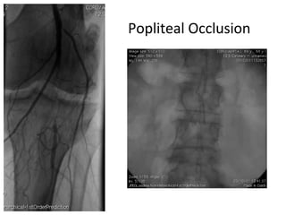Popliteal Occlusion 
 