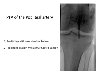 PTA of the Popliteal artery 
1) Predilation with an undersized balloon 
2) Prolonged dilation with a Drug Coated Balloon 
 