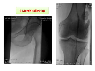 66 MMoonntthh FFoollllooww uupp 
 