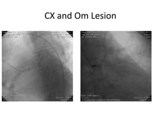 CX and Om Lesion 
 