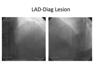 LAD-Diag Lesion 
 
