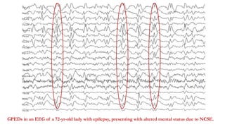 GPEDs in an EEG of a 72-yr-old lady with epilepsy, presenting with altered mental status due to NCSE.
 