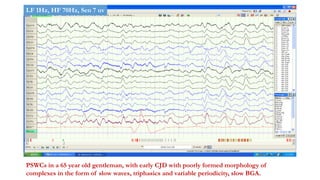 PSWCs in a 65 year old gentleman, with early CJD with poorly formed morphology of
complexes in the form of slow waves, triphasics and variable periodicity, slow BGA.
LF 1Hz, HF 70Hz, Sen 7 uv
 