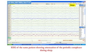 Sleep
EEG of the same patient showing attenuation of the periodic complexes
during sleep.
LF 1Hz, HF 70Hz, Sen 7 uv
 