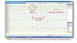 250 ms
1.5- 2Hz
Interval of 600 ms
PSWCs in a 58 year old lady with CJD symptomatic for 2 months. Average referential montage.
LF 1Hz, HF 70Hz, Sen 7 uv
 