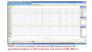 PSWCs in a 62 year old lady with advanced CJD characterised by 1 Hz
generalised complexes of 250 ms duration, with interval of 800- 1000 ms.
LF 1Hz, HF 70Hz, Sen 7 uv
 