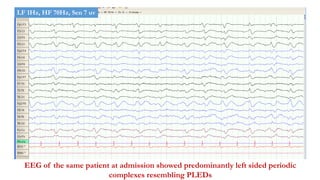 EEG of the same patient at admission showed predominantly left sided periodic
complexes resembling PLEDs
LF 1Hz, HF 70Hz, Sen 7 uv
 