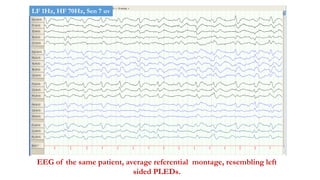 EEG of the same patient, average referential montage, resembling left
sided PLEDs.
LF 1Hz, HF 70Hz, Sen 7 uv
 