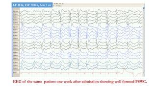 EEG of the same patient one week after admission showing well formed PSWC.
LF 1Hz, HF 70Hz, Sen 7 uv
 