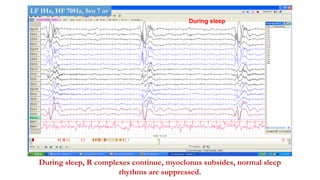 During sleep
During sleep, R complexes continue, myoclonus subsides, normal sleep
rhythms are suppressed.
LF 1Hz, HF 70Hz, Sen 7 uv
 