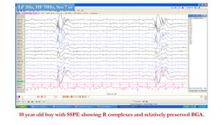 10 year old boy with SSPE showing R complexes and relatively preserved BGA.
LF 1Hz, HF 70Hz, Sen 7 uv
 