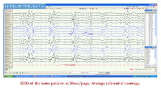 EEG of the same patient- at 20sec/page. Average referential montage.
LF 1Hz, HF 70Hz, Sen 7 uv
 