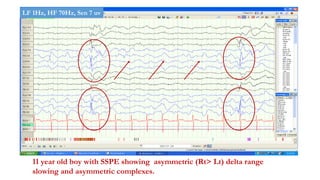 11 year old boy with SSPE showing asymmetric (Rt> Lt) delta range
slowing and asymmetric complexes.
LF 1Hz, HF 70Hz, Sen 7 uv
 