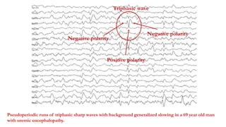 Pseudoperiodic runs of triphasic sharp waves with background generalized slowing in a 69 year old man
with uremic encephalopathy.
Triphasic wave
Negative polarity
Positive polarity
Negative polarity
 