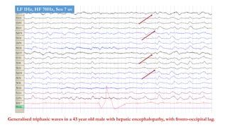Generalised triphasic waves in a 43 year old male with hepatic encephalopathy, with fronto-occipital lag.
LF 1Hz, HF 70Hz, Sen 7 uv
 