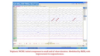 Triphasic NCSE: initial component is small and of short duration. Abolished by BZD, with
improvement in responsiveness.
LF 1Hz, HF 70Hz, Sen 7 uv
 