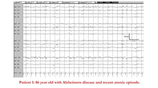 Patient 1: 86 year old with Alzheimers disease and recent anoxic episode.
 