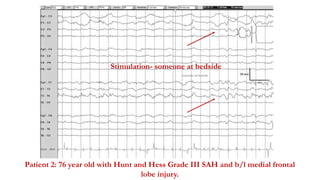 Patient 2: 76 year old with Hunt and Hess Grade III SAH and b/l medial frontal
lobe injury.
Stimulation- someone at bedside
 