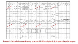 Patient 2: Stimulation consistently generated left hemispheric ical appearing discharges.
 