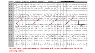 Patient 3: After vigorous or repetitive stimulation, this pattern often became a focal ictal-
appearing pattern.
 