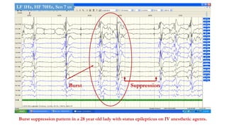 Burst suppression pattern in a 28 year old lady with status epilepticus on IV anesthetic agents.
Burst Suppression
LF 1Hz, HF 70Hz, Sen 7 uv
 