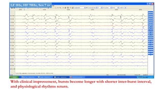With clinical improvement, bursts become longer with shorter inter-burst interval,
and physiological rhythms return.
LF 1Hz, HF 70Hz, Sen 7 uv
 