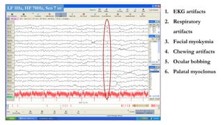 1. EKG artifacts
2. Respiratory
artifacts
3. Facial myokymia
4. Chewing artifacts
5. Ocular bobbing
6. Palatal myoclonus
LF 1Hz, HF 70Hz, Sen 7 uv
 