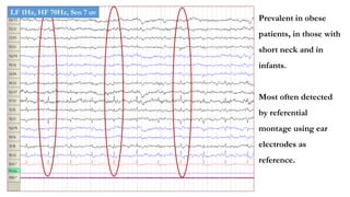 Prevalent in obese
patients, in those with
short neck and in
infants.
Most often detected
by referential
montage using ear
electrodes as
reference.
LF 1Hz, HF 70Hz, Sen 7 uv
 