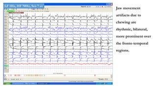 Jaw movement
artifacts due to
chewing are
rhythmic, bilateral,
more prominent over
the fronto temporal
regions.
LF 1Hz, HF 70Hz, Sen 7 uv
 