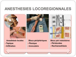 ANESTHESIES LOCOREGIONNALES
Anesthésie locales
- Topique
- Infiltration
Blocs périphériques
- Plexique
- tronculaire
Blocs péri médullaires
- Péridurales
- Rachianesthésie
 