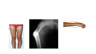 Generalities THE GENERALITIES ON BONE FRACTURES AND PRINCIPLES OF MANAGEMENT.pptx