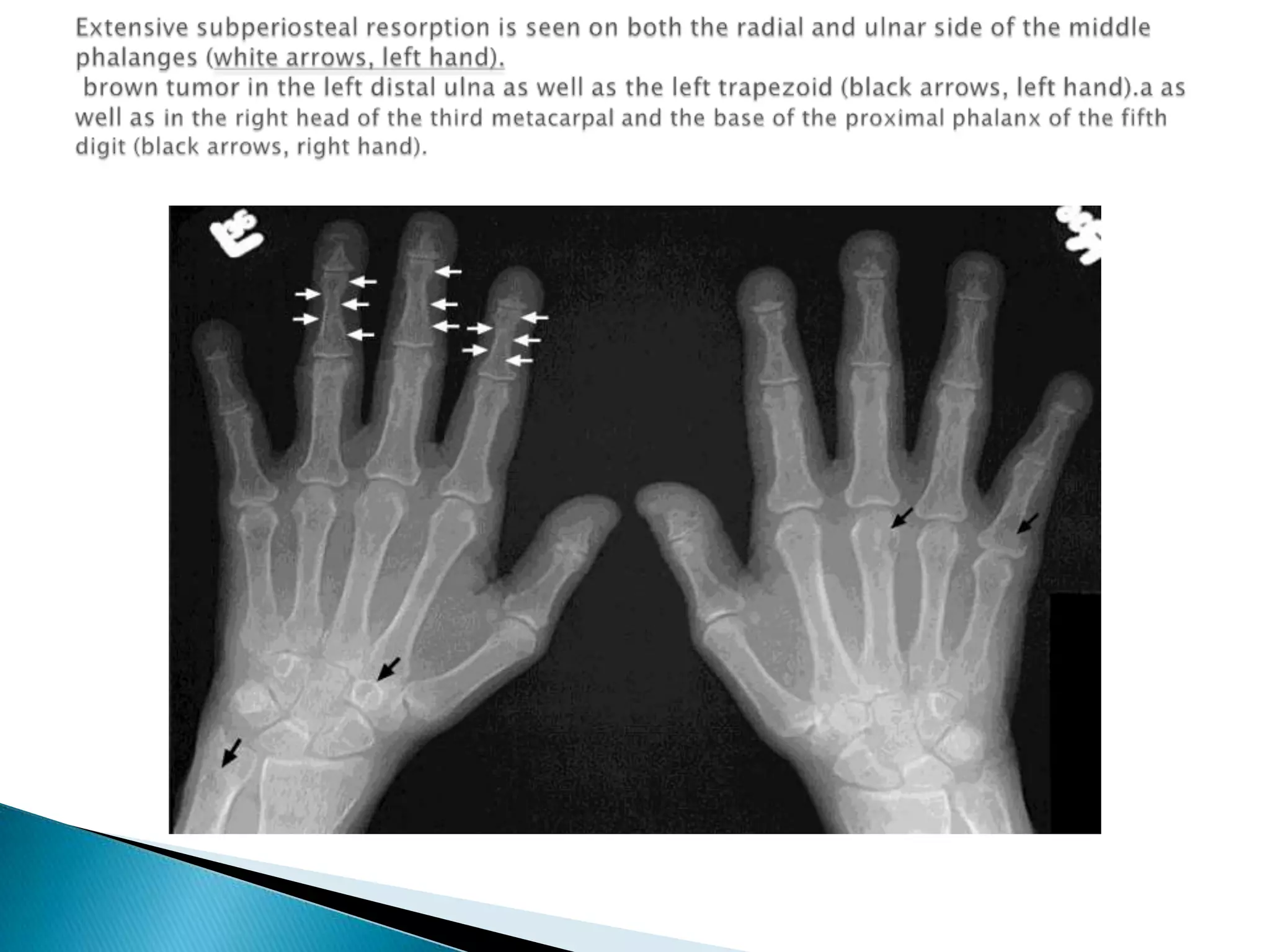 Extensive subperiostealresorption is seen on both the radial and ulnar side of the middle phalanges (white arrows, left hand). brown tumor in the left distal ulna as well as the left trapezoid (black arrows, left hand).a as well as in the right head of the third metacarpal and the base of the proximal phalanx of the fifth digit (black arrows, right hand). 