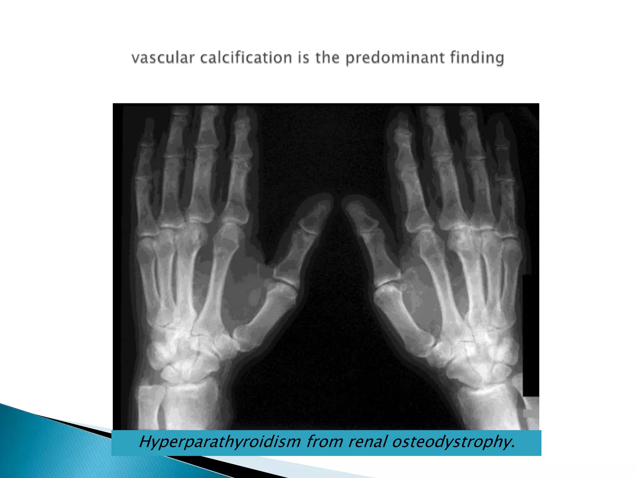 vascular calcification is the predominant findingHyperparathyroidism from renal osteodystrophy.