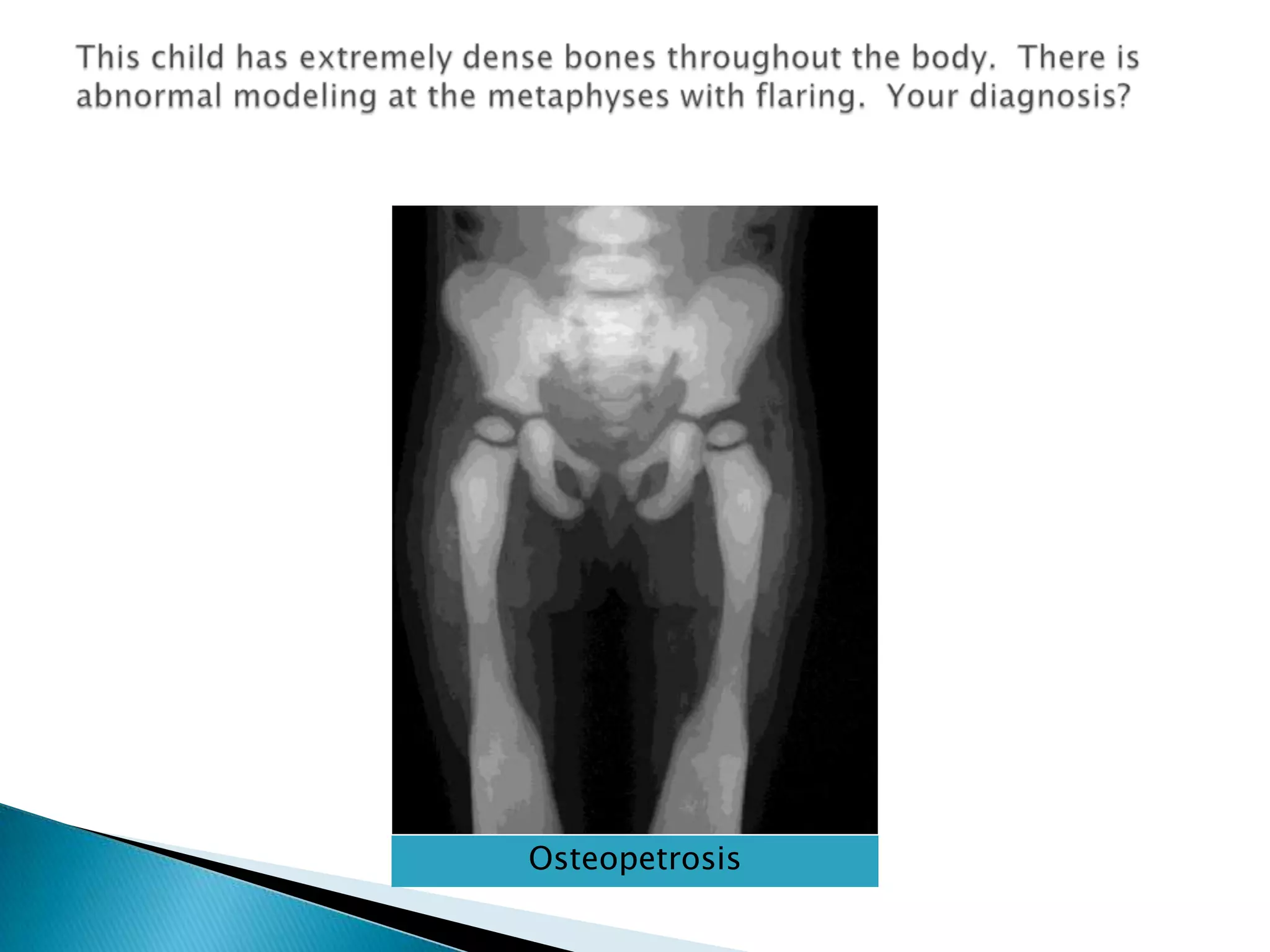This child has extremely dense bones throughout the body.  There is abnormal modeling at the metaphyses with flaring.  Your diagnosis?Osteopetrosis