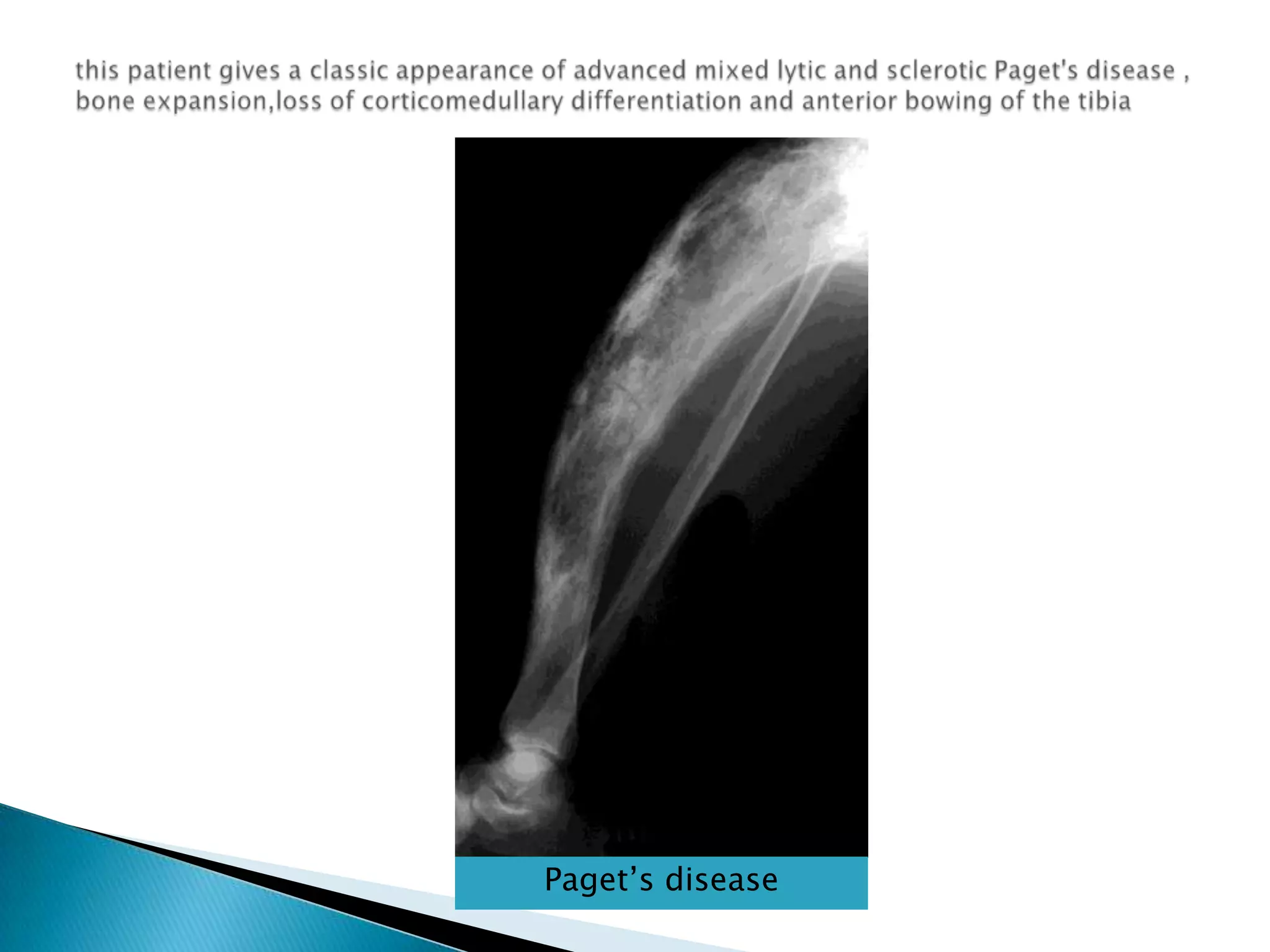 this patient gives a classic appearance of advanced mixed lytic and sclerotic Paget's disease , bone expansion,loss of corticomedullary differentiation and anterior bowing of the tibiaPaget’s disease